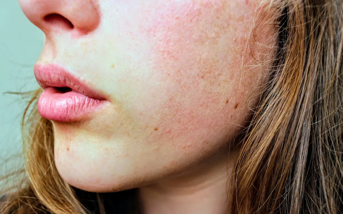 Close-up of reactive, sensitive skin showing redness on the cheeks